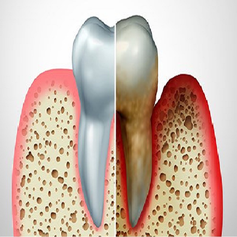 doctor,calpe.english,speaking,altea,albir,costa,blanca,villajoyosa,hormone,hormonas,BHRT,sustitution,sustitution,consultant,britannia,clinica,dentist,tooth,diente,gingivitis,gum,encía