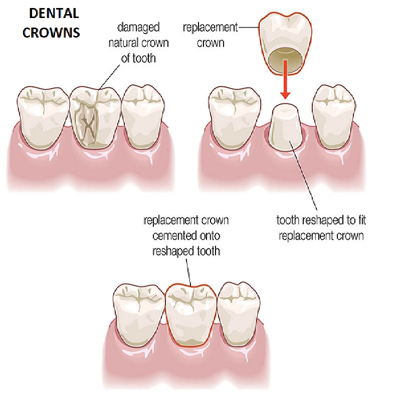 dentist-doctor-arzt-english-british-speaking-calpe-deutschprachiger-altea-zahnarzt-benissa-costa-blanca-albir-notfall-moraira-covid-vithas-pcr-hormone-oral-internist-19-crown-dental.jpg