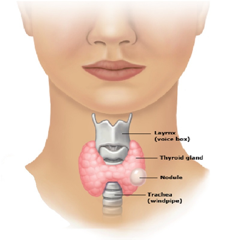 Thyroid nodules.