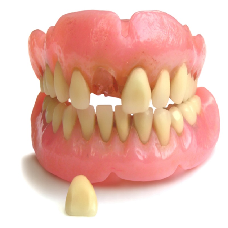 Due to the massive impact that broken dentures can have on your life, the damage is considered a dental emergency. We offer 24H emergency dental services and can help you repair your broken denture quickly and efficiently. Our dentists and specialists can help you with if: You lost a tooth from your dentures; A tooth on your dentures broke; A tooth fell off your dentures; Your dentures cracked. It is essential not to try and repair cracked dentures yourself. Even a minor misalignment in the fixed dentures can create a lack of suction, which in turn can lead to the dentures breaking again soon after you have repaired them or even causing damage inside your mouth.