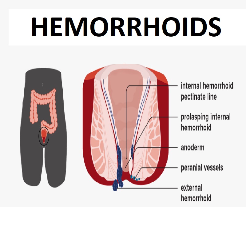 Four out of five people will experience hemorrhoids in their lifetime. Also known as piles, hemorrhoids are essentially swollen or inflamed