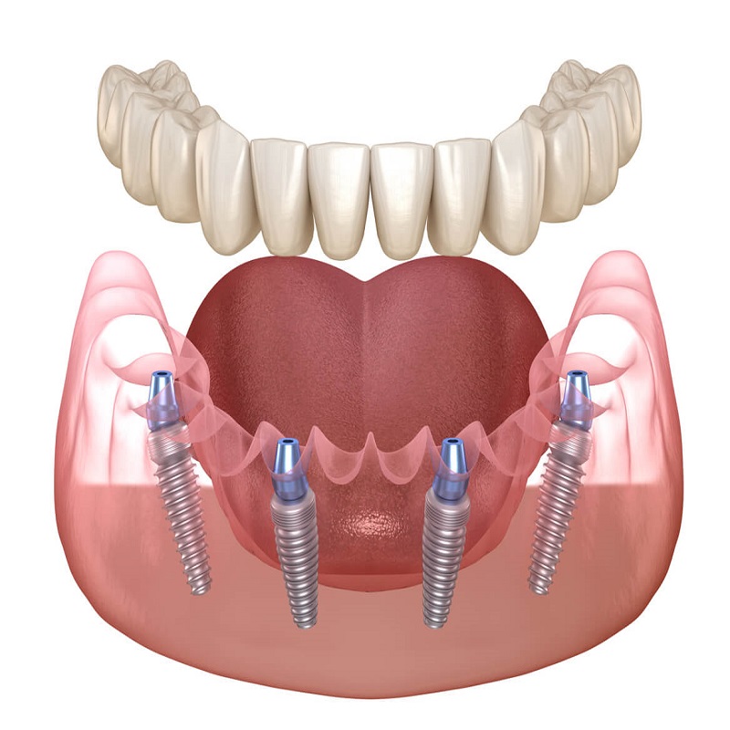 dentist-doctor-arzt-english-british-speaking-calpe-deutchsprachiger-altea-zahnarzt-benissa-blanca-albir-notfall-moraira-covid-19-test-pcr-zahn-invisalign-factor-implant.jpg