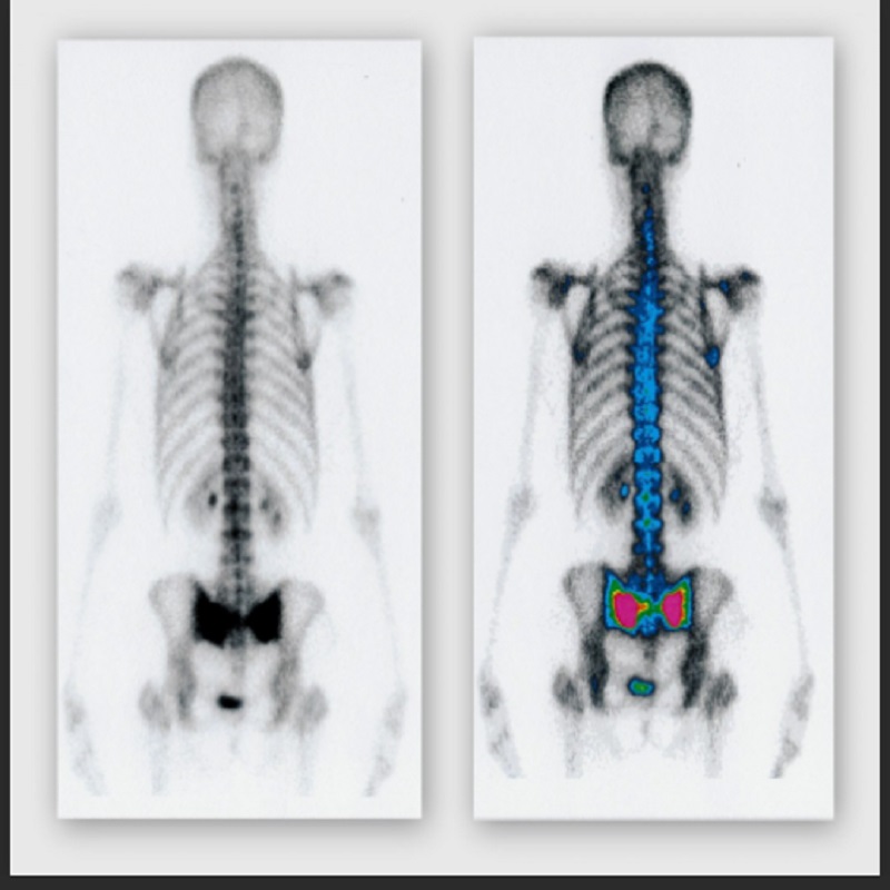 Why it's done Bbone scans depicting hot spots Hot spotsOpen pop-up dialog box A bone scan might help determine the cause of unexplained bone pain. The test is sensitive to differences in bone metabolism, which are highlighted in the body by the radioactive tracer. Scanning the whole skeleton helps in diagnosing a wide range of bone disorders, including: Fractures Arthritis Paget's disease of bone Cancer originating in bone Cancer that has metastasized to bone from a different site Infection of the joints, joint replacements or bones