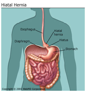 Fatigue Des Longues Listes D Attente Pour Chirurgie Digestive Hernie Hiatale