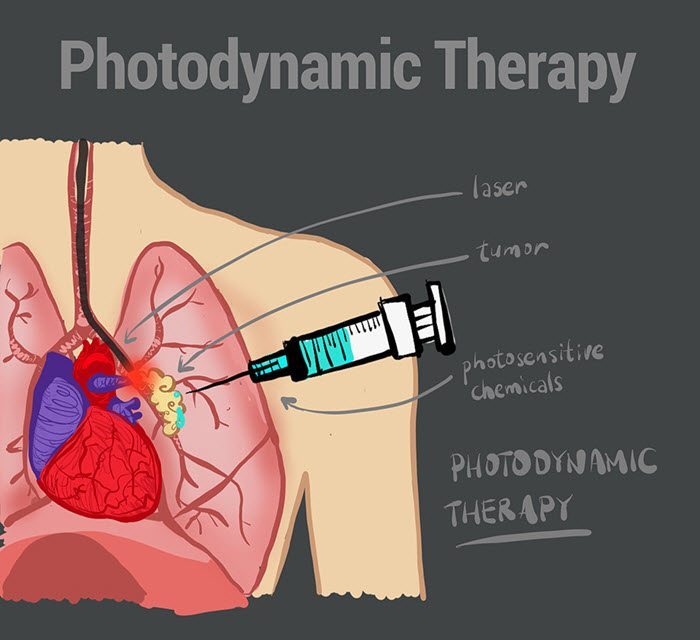 Photodynamic Therapy Pdt Intralesional Photodynamic Therapy For Anal