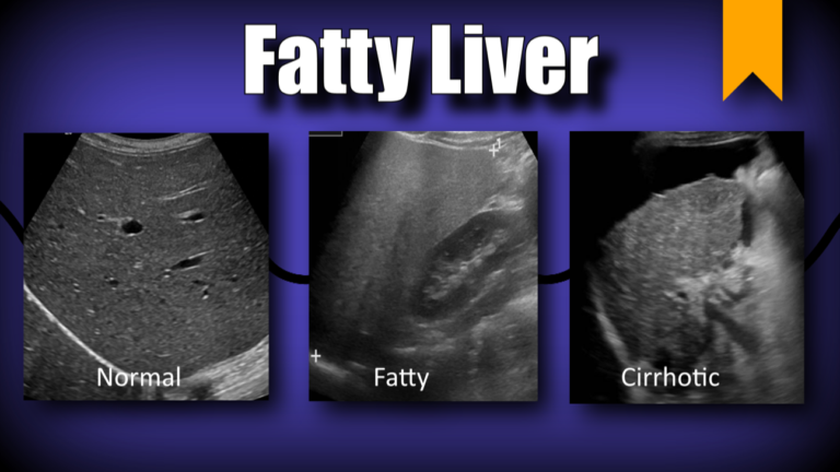 non-alcoholic-fatty-liver-disease-nafld-clinica-britannia