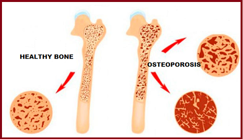 How To Know If You Have Osteoporosis?. CLINICA BRITANNIA – Clinica ...