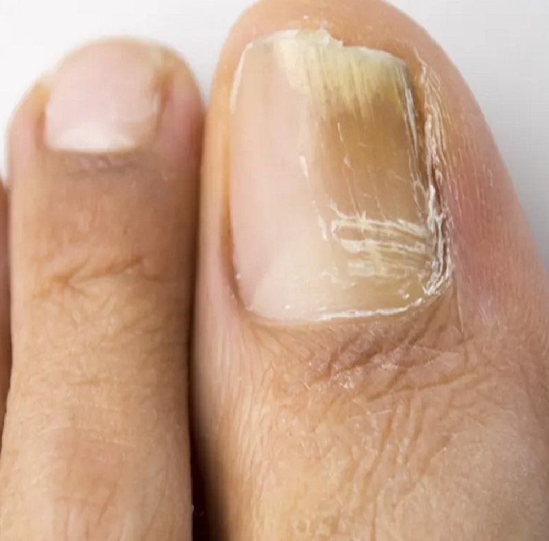 Onychomicosis. Visit our Podiatrist. 07/02/2022.. CLINICA BRITANNIA ...