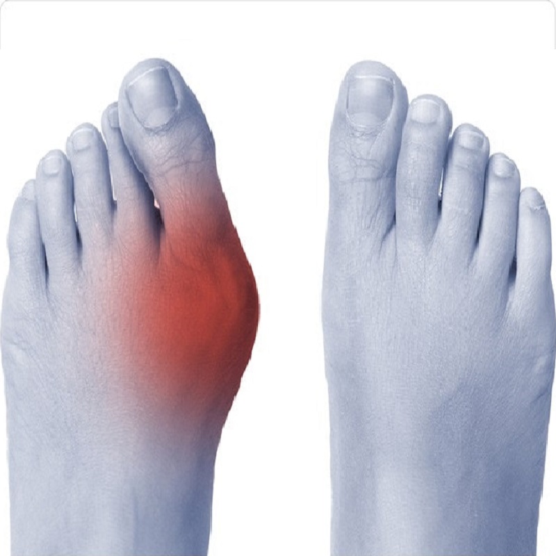 Hallux Valgus. Visit our Podiatrist. 24/03/2022 – Clinica Britannia