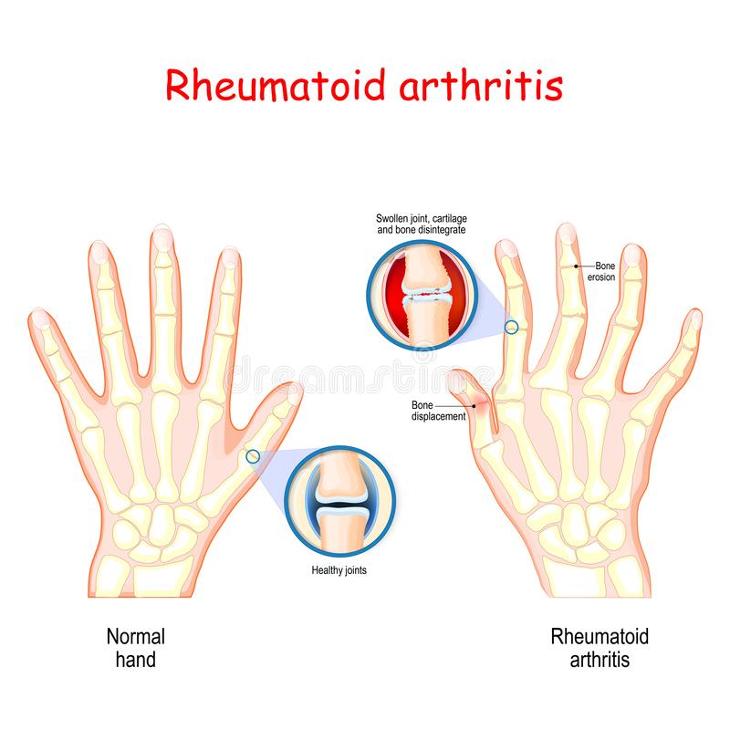 Dangerousness Rheumatoid Arthritis (RA). 20/05/22 – Clinica Britannia